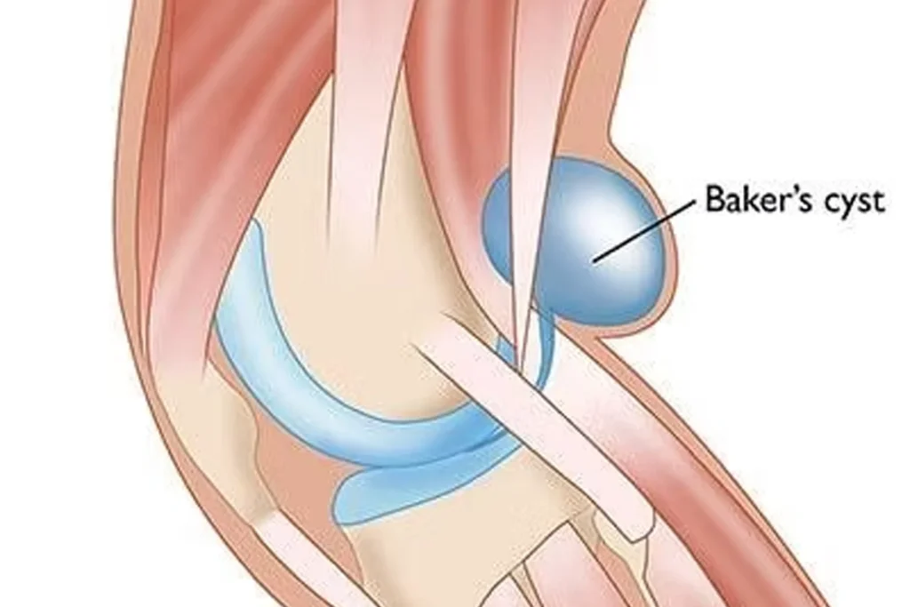 Baker Kisti Nedir? Diz Arka Kısmında Şişlik Hissi | Uzm.fzt. Onur Seyrek Baker Kisti Nedir? Diz Arka Kısmında Şişlik Ve Tedavisi