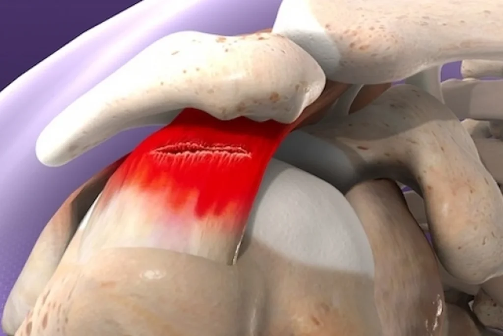 Müzisyenlerde Rotator Cuff Tendinopatisi: Omuz Ağrısı Neden Olur? | Uzm.fzt. Onur Seyrek Müzisyenlerde Rotator Cuff Tendinopatisi Ve Omuz Ağrısı