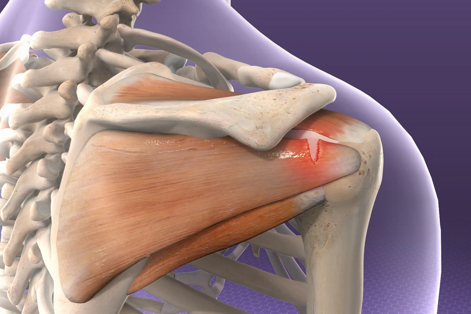 Müzisyenlerde Rotator Cuff Tendinopatisi Ve Omuz Ağrısı