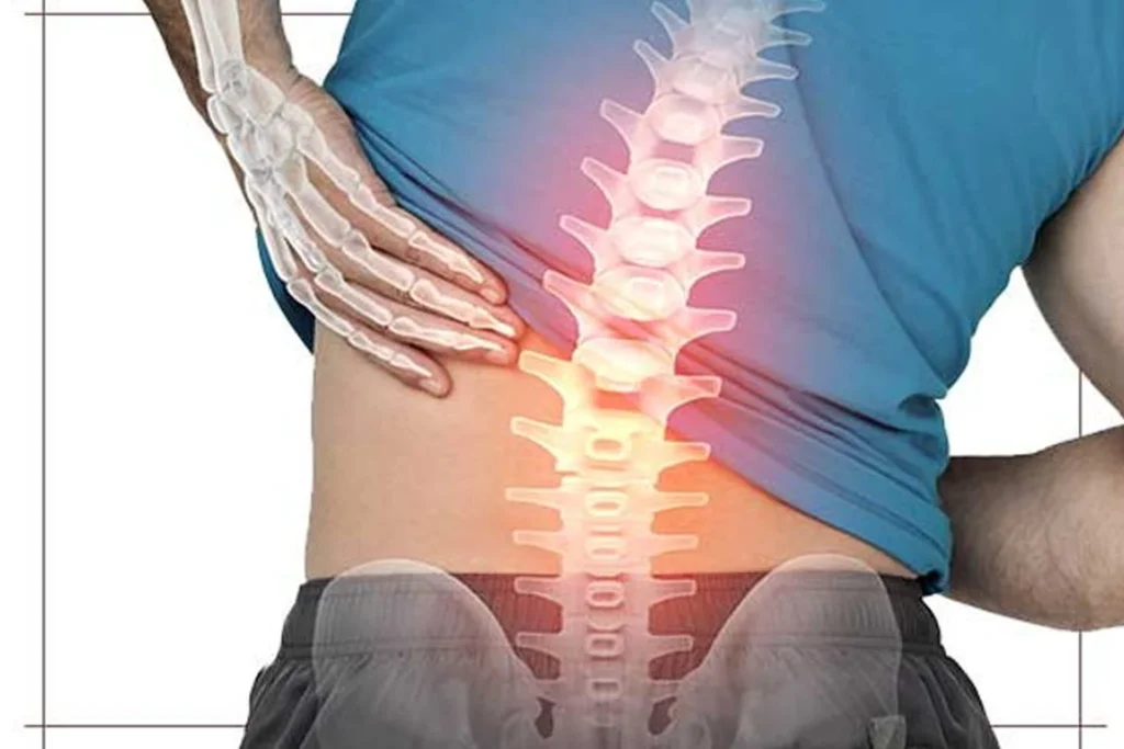 Spinal Stenoz (Kanal Daralması) Nedir? Kimlerde Görülür? | Uzm.fzt. Onur Seyrek Spinal Stenoz Nedir? Belde Kanal Daralması Kimlerde Görülür?