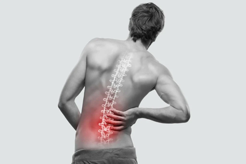 Bel Kayması (Spondilolistezis) Nedir, Belirtileri Ve Tanısı | Uzm.fzt. Onur Seyrek Bel Kayması (Spondilolistezis) Nedir, Belirtileri Ve Tanısı