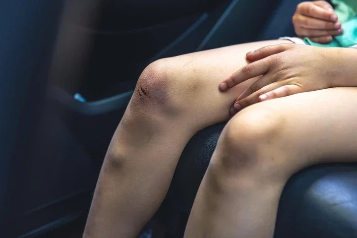 Legg-Calve-Perthes Hastalığı Çocuklarda Kalça Ağrısının Ardındaki Ciddi Neden
