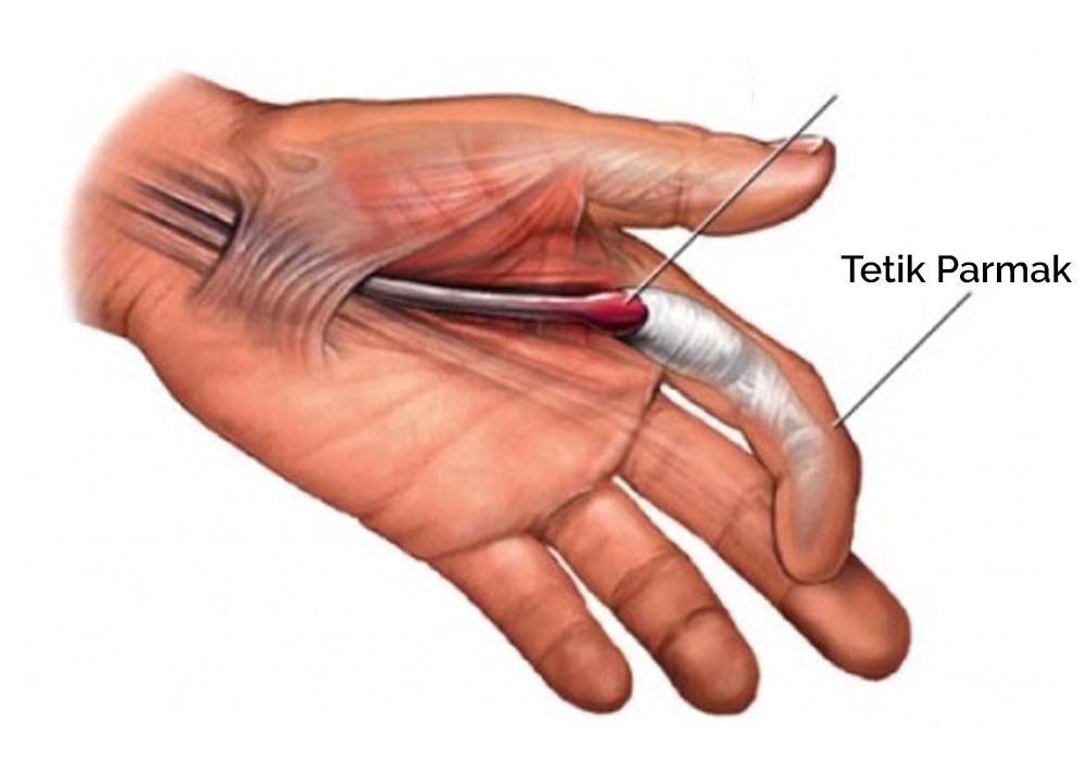 Tetik Parmak: Kilitlenen Parmağa 5 Etkili Tedavi