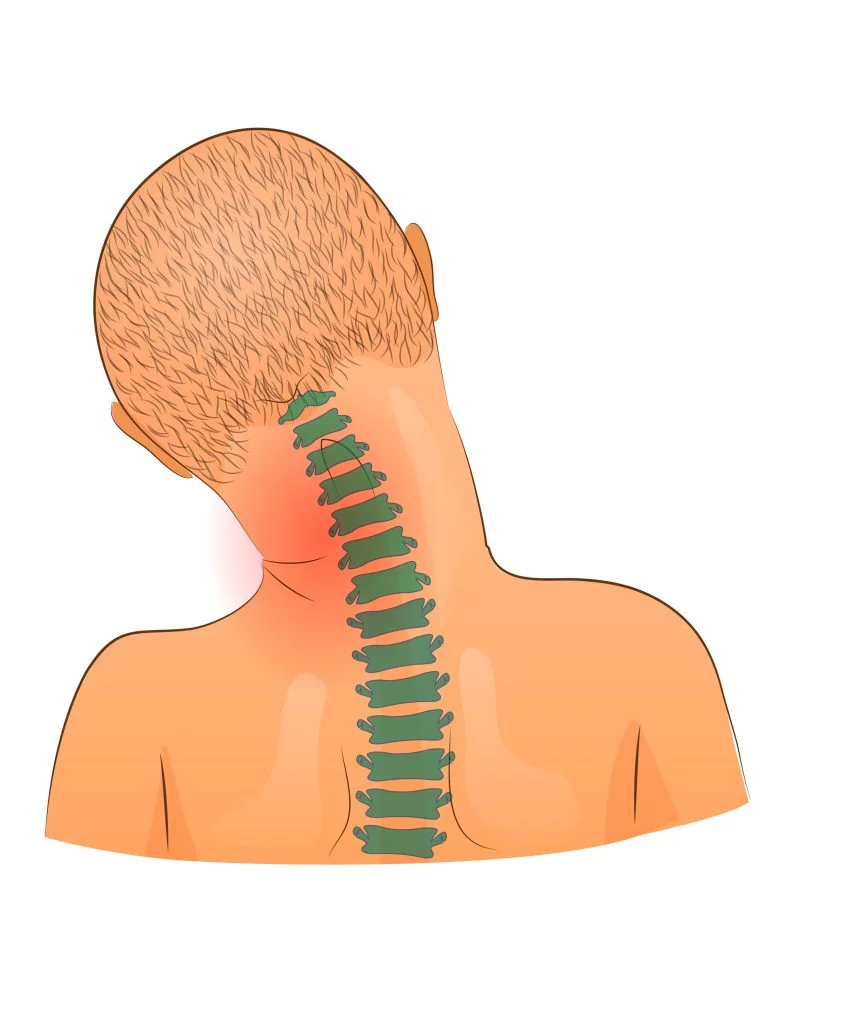 Tortikolis Nedir? Boyun Kilitlenmesine 5 Çözüm